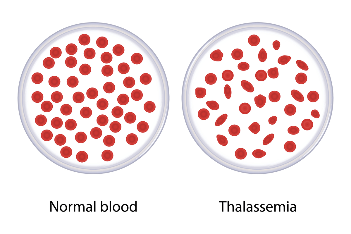 نحوه تشخیص تالاسمی در آزمایش خون چگونه است