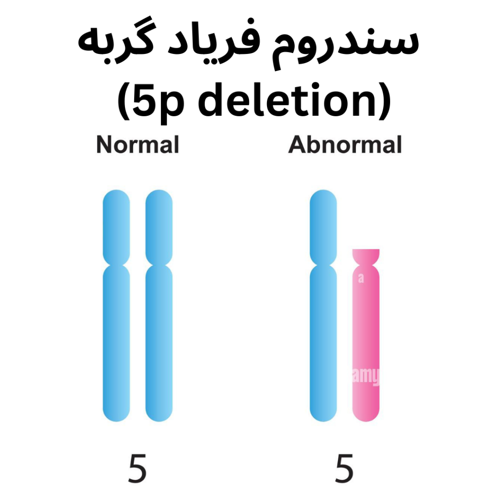 سندرم ژنتیکی فریاد گربه