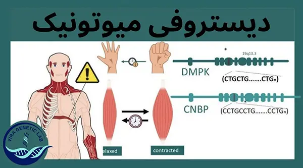 دیستروفی میوتونیک DM