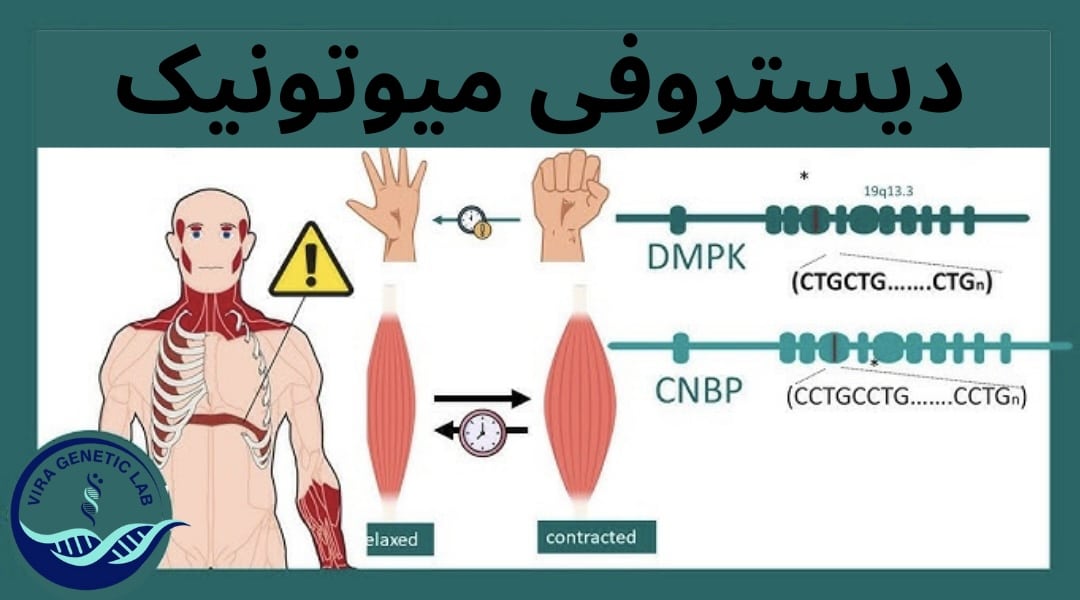 دیستروفی میوتونی DM