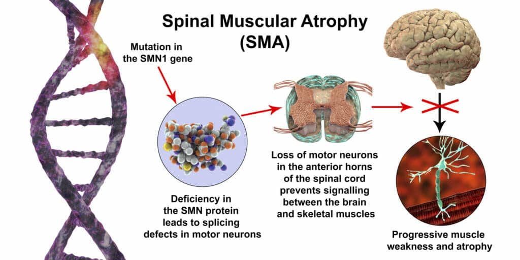 بیماری ژنتیکی آتروفی عضلانی نخاعی (SMA)