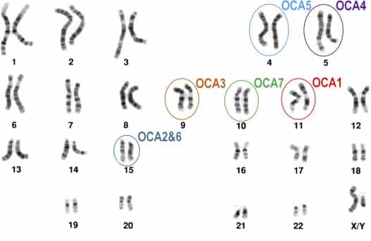 موقعیت کروموزومی ژن های جهش یافته در انواع مختلف OCA