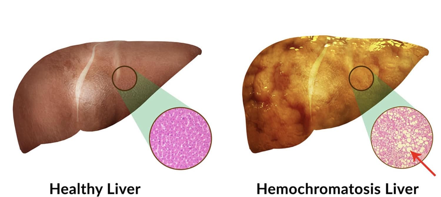 کبد در بیماری هموکروماتوز
