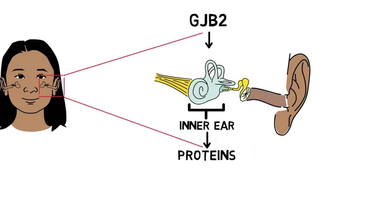 ناشنوایی ژنتیکی به دلیل جهش GJB2