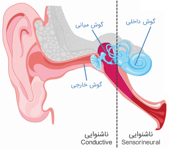 ناشنوایی