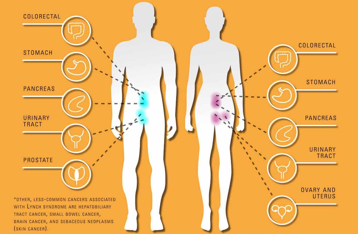 سرطان های شایع در سندرم لینچ