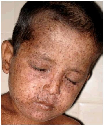 فرد مبتلا به بیماری گزرودرما پیگمنتوزوم (Xeroderma Pigmentosum - XP)